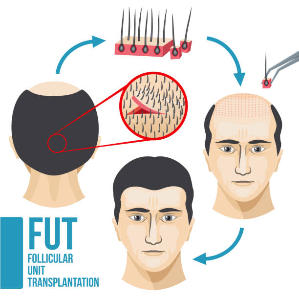 Male hair loss treatment medical vector infographic Male hair loss treatment medical vector infographic. Disease hair and baldness, growth and transplant hair illustration follicular thyroid cancer stock illustrations