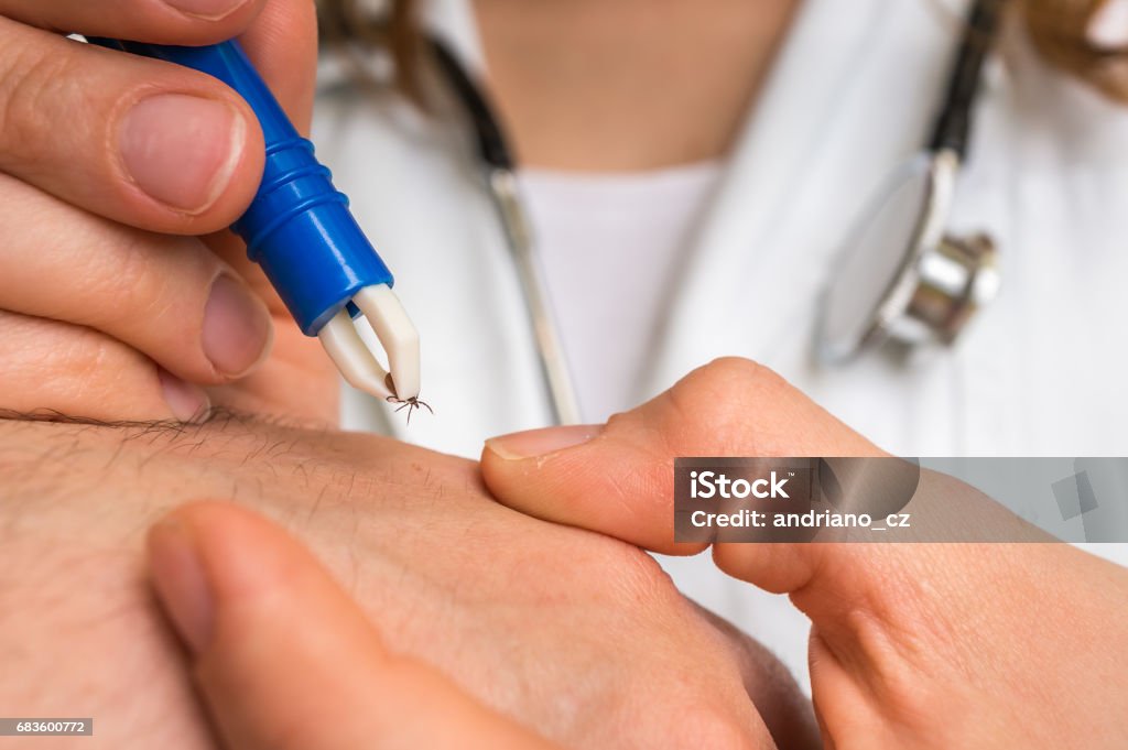 Doctor removing a tick with tweezers from hand of patient Female doctor removing a tick with tweezers from hand of patient. Encephalitis, borreliosis and lyme disease. Tick - Animal Stock Photo
