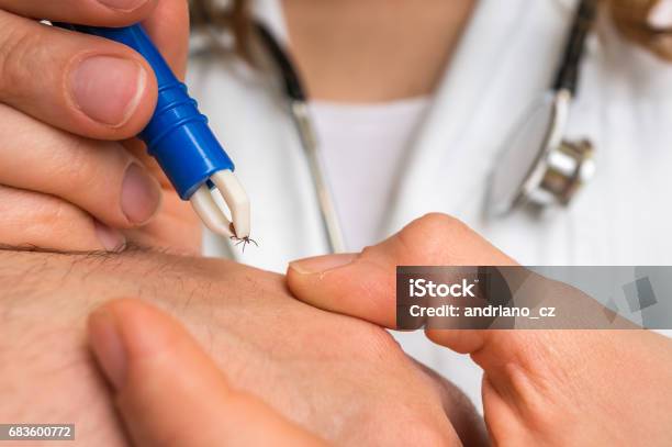 Doctor Removing A Tick With Tweezers From Hand Of Patient Stock Photo - Download Image Now