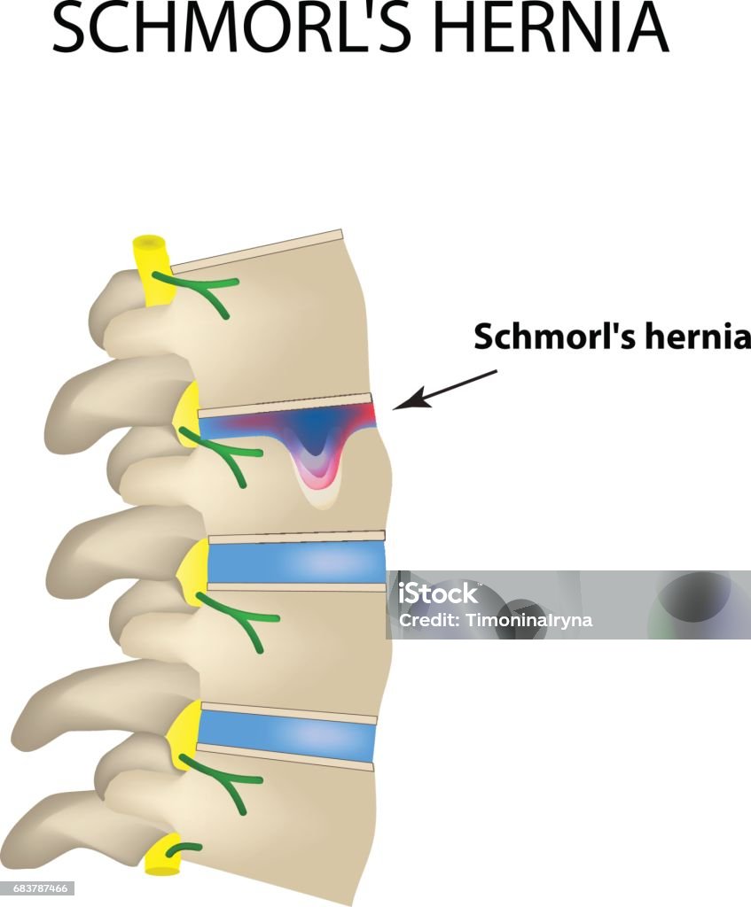 Hernia Schmorl. Intervertebral disc. Side view. Spine. Infographics Vector illustration on isolated background Hernia Schmorl. Intervertebral disc. Side view. Spine. Infographics. Vector illustration on isolated background Anatomy stock vector