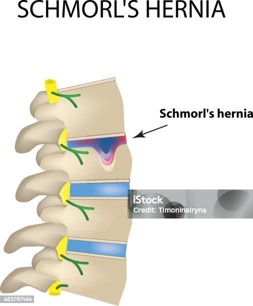 Hernia Schmorl Intervertebral Disc Side View Spine Infographics Vector Illustration On Isolated Background Stock Illustration - Download Image Now