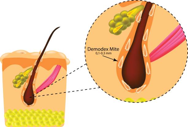 The structure of the hair. Sebaceous gland. Introduction of demodex mite. Demodecosis. Infographics. Vector illustration on isolated background The structure of the hair. Sebaceous gland. Introduction of demodex mite. Demodecosis. Infographics. Vector illustration on isolated background. follicular thyroid cancer stock illustrations