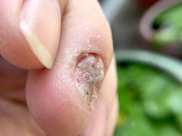 istock Fungal nail infection and damage on human hand. 683974110