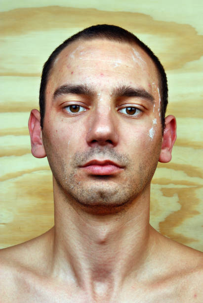 Young man with a chronic infection of the skin Young man with a chronic infection of the skin on the face male yeast infection symptoms stock pictures, royalty-free photos & images