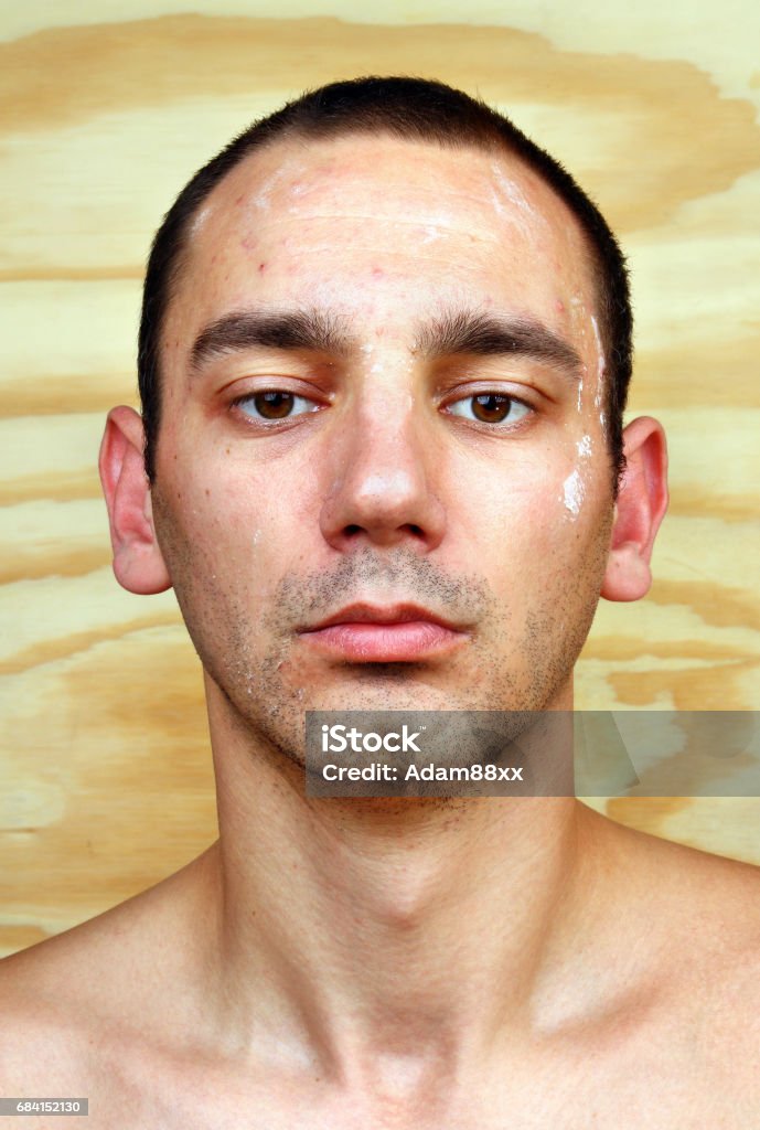 Young man with chronic infected candida albicans Young man with chronic infected candida albicans skin on the face Acne Stock Photo
