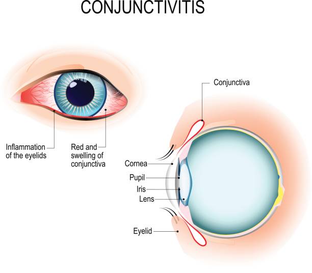 결막염입니다. 인간의 눈의 외부 보기 및 수직 섹션 - sclera stock illustrations