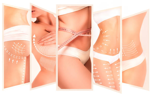 the cellulite removal plan. white markings on young woman body - beautiful body imagens e fotografias de stock