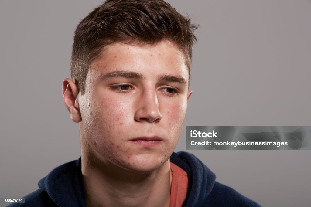 Adolescente com a acne que olha para baixo, retrato da cabeça e dos ombros - Foto de stock de Acne royalty-free