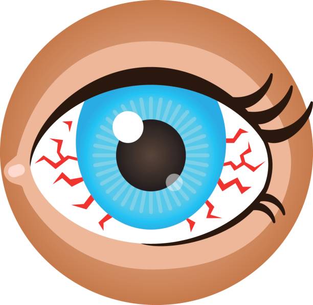 Ojos Irritados Vectores Libres de Derechos - iStock Ojos Irritados Vectores Libres de Derechos - iStock