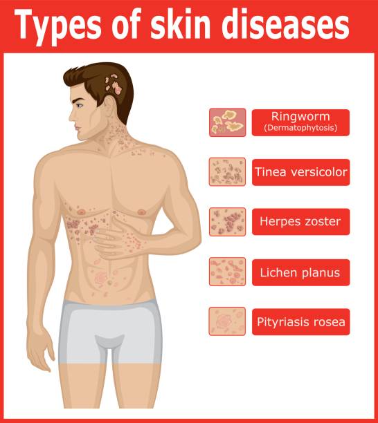 Types of skin diseases Types of skin diseases on the body of a young man shingles rash stock illustrations