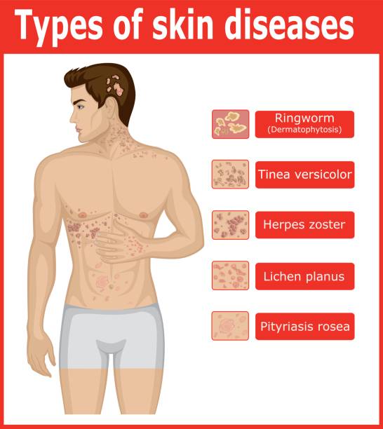 Types of skin diseases Types of skin diseases on the body of a young man tinea stock illustrations