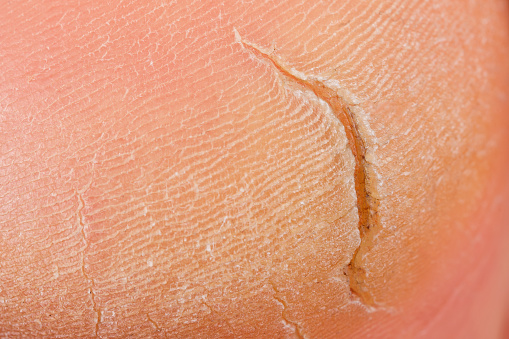 Close up picture of cracked dry human heel, painful