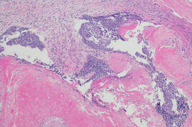 pilomatricoma förkalkade epitelioma (hals folliklar) - basalcellscancer bildbanksfoton och bilder