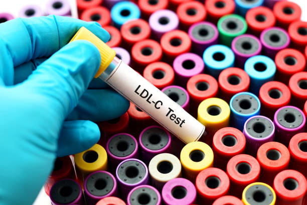 Ldl Test 4,300+ Lipoprotein Stock Photos, Pictures & Royalty-Free Images - iStock