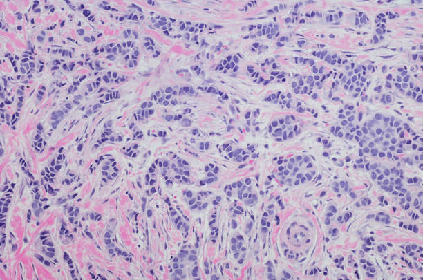 Invasive lobular carcinoma of the breast. Invasive lobular carcinoma of the breast. Invasive lobular carcinoma (ILC), sometimes called infiltrating lobular carcinoma, is the second most common type of breast cancer after invasive ductal carcinoma. Hematoxylin and eosin staining (H&E) H&E histology stock pictures, royalty-free photos & images