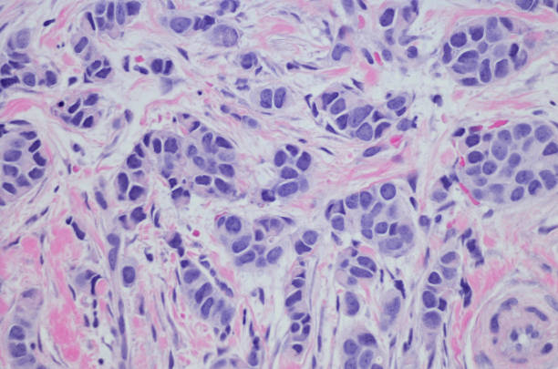 istock Invasive lobular carcinoma of the breast. 686786502