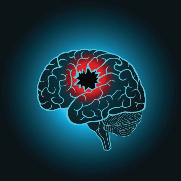 istock A brain with a hole, the concept of destruction of the brain, memory, stroke 686876498