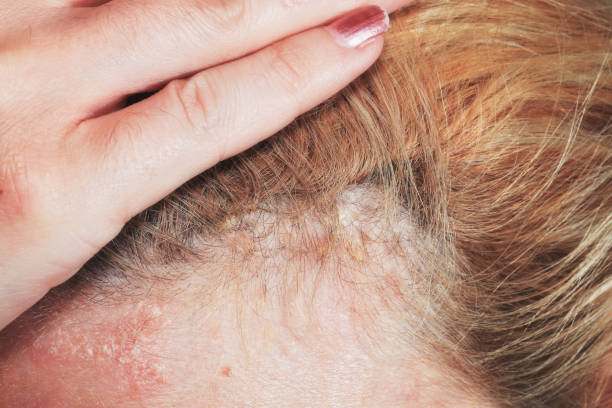 psoriasis cheveux - human scalp photos et images de collection