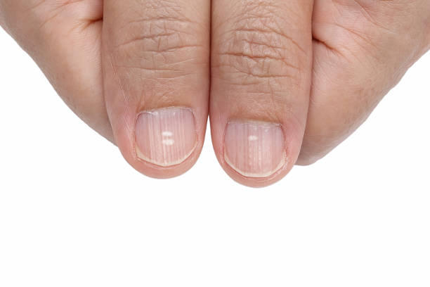 White Spots And Vertical Ridges On The Fingernails Stock Photo - Download Image Now - Fingernail, Spotted, White Color - iStock White Spots And Vertical Ridges On The Fingernails Stock Photo - Download Image Now - Fingernail, Spotted, White Color - iStock