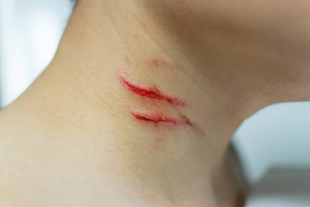 Skin Abrasion Skin wound (Abrasion) on the neck skin scrape stock pictures, royalty-free photos & images