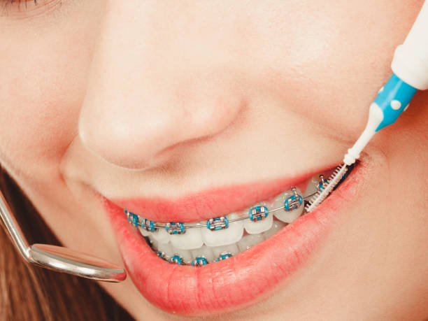 istock Woman smiling cleaning teeth with braces 687701538