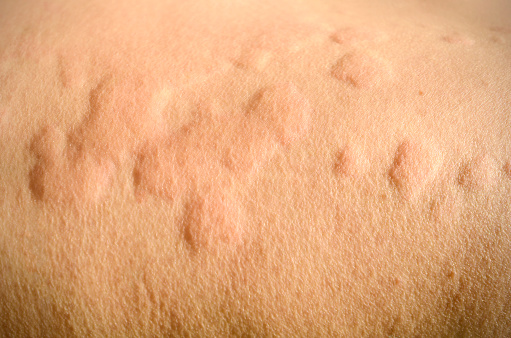 Reacción de piel erupción cutánea, Urticaria, alérgicas de la piel. photo