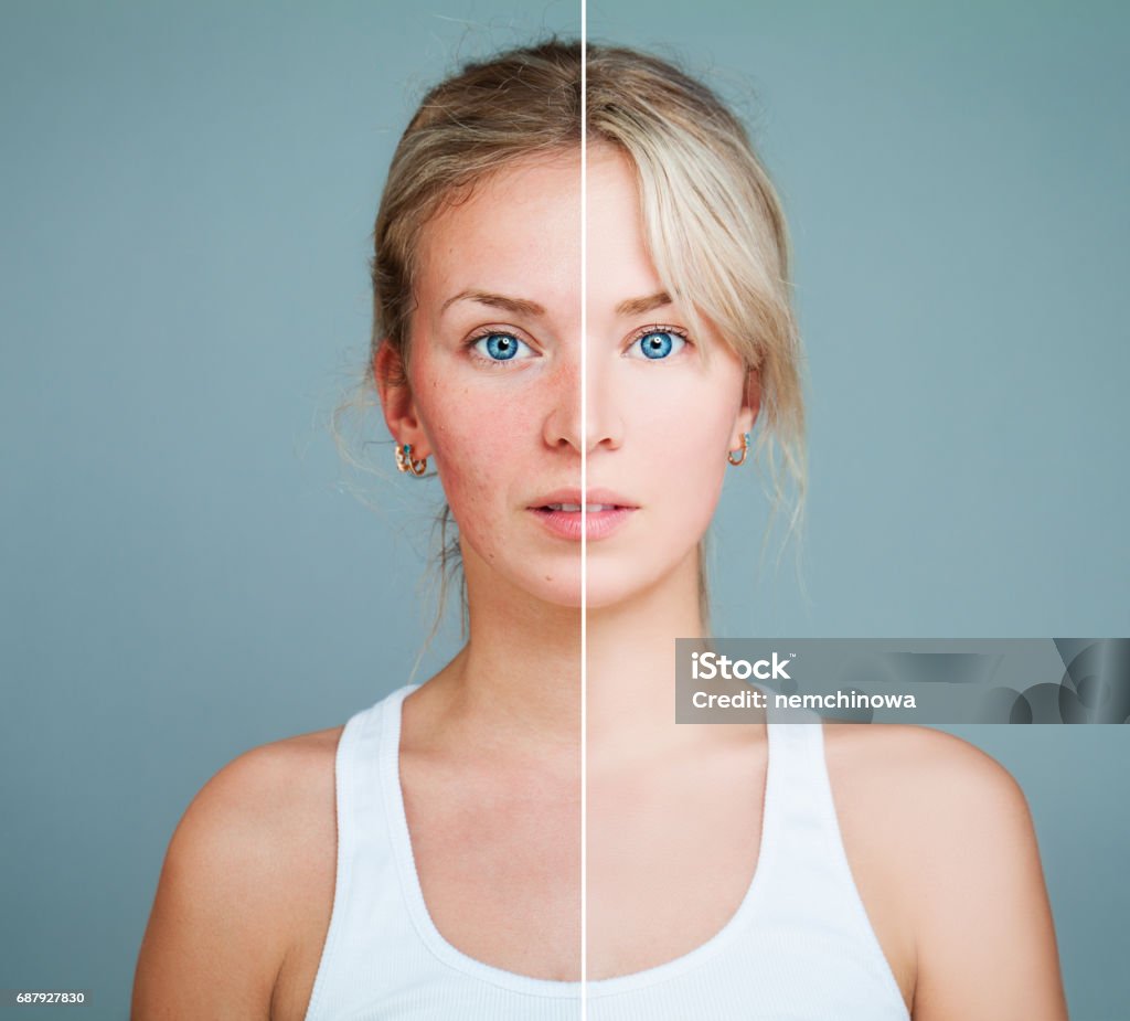 肌の問題を抱えた若いモデル女性。女性の顔は、2つの部分に分かれて1健康と1不健康。フェイシャルトリートメント、医学、美容概念 - 皮膚のロイヤリティフリーストックフォト