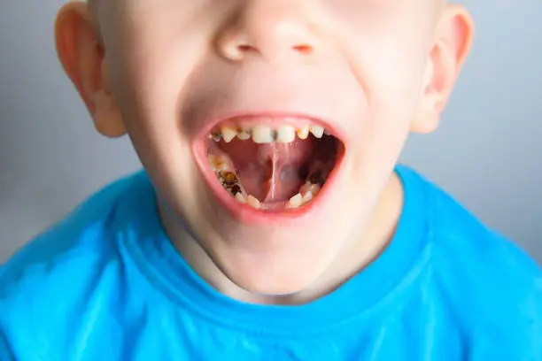 Caries on the teeth of a young child blue t-shirt