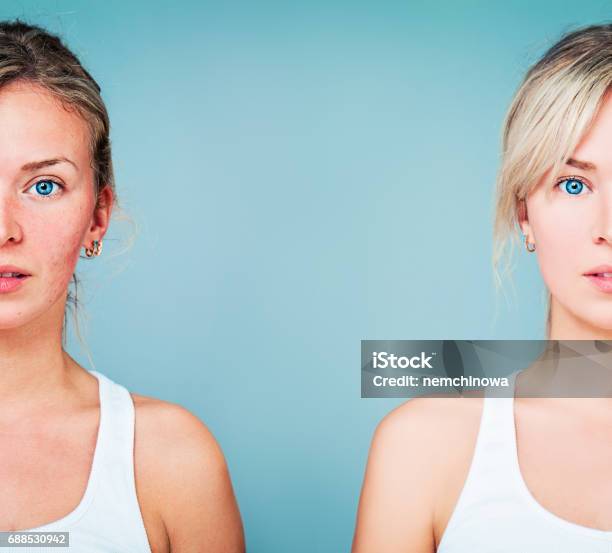 Young Woman With Perfect Skin And Skin Problem Unhealthy And Healthy Skin After Treatment Stock Photo - Download Image Now