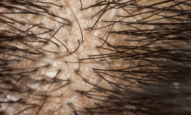 istock Dandruff on scalp and dark hair. Macro shot. 688570730