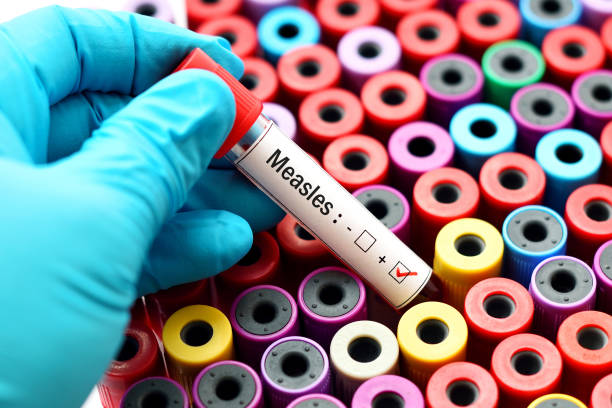 Measles positive Blood sample positive with Measles virus measles stock pictures, royalty-free photos & images