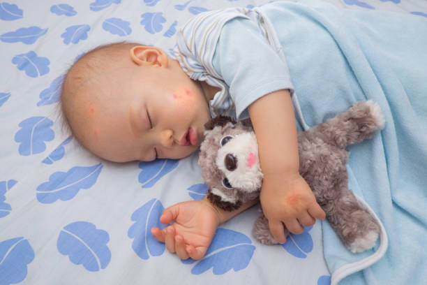 istock Sleeping Asian baby with red spot, blister from mosquito bite 689237648