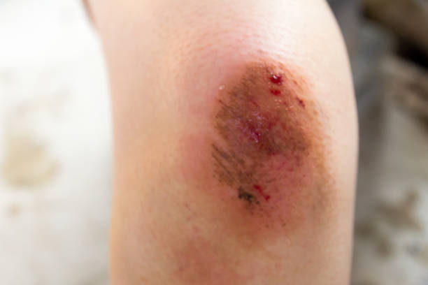 istock Bruised wound injury on woman knee background 689256266