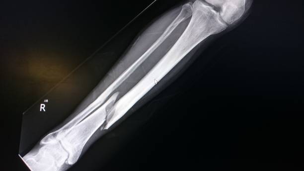 Tibia Fracture X-Ray image of a tibial fracture tibia photos stock pictures, royalty-free photos & images