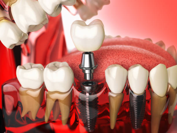 istock Tooth implant in the model human teeth. Dental medicine stomatology 689313528