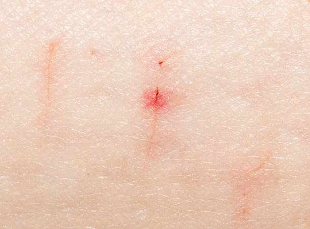 istock a wound on the skin. close 689521264