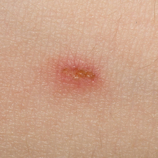 istock a wound on the skin. close 689537370