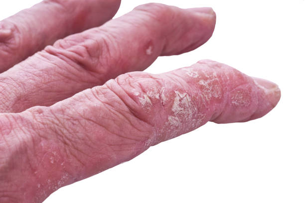 istock Psoriasis, skin disease 689568318
