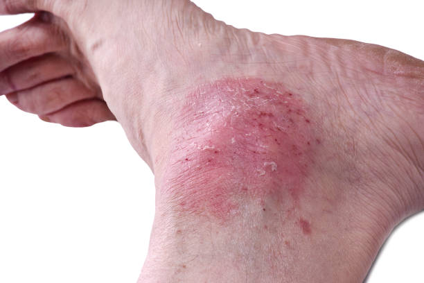 istock Psoriasis, skin disease 689568580