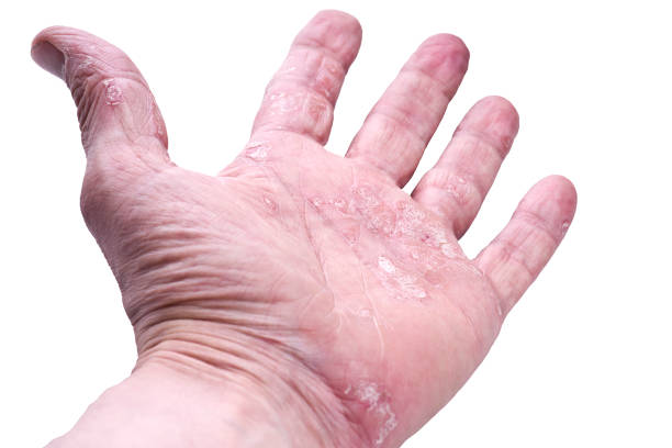 istock Psoriasis, skin disease 689568696