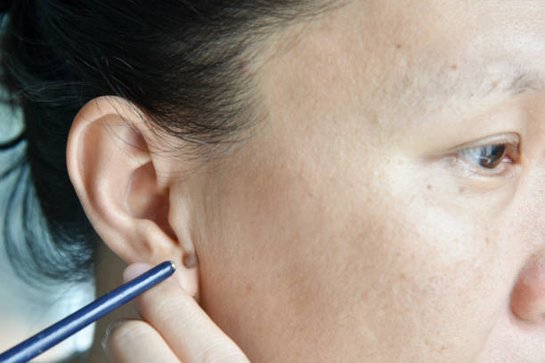 istock asian woman point mole on her ear, prepared to remove 689579640