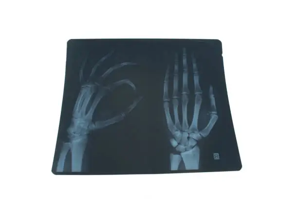 Photo of X-ray of a hand