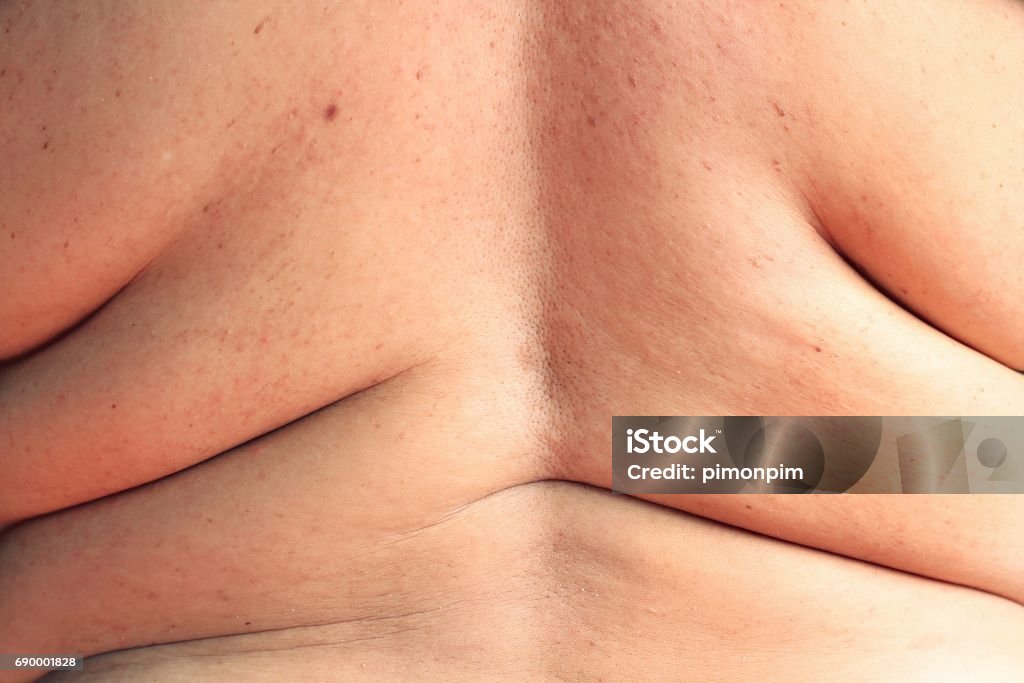 Frauen zeigt überschüssiges Fett des Rückens - Lizenzfrei Dick Stock-Foto