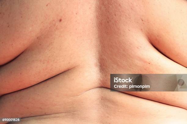 Frauen Zeigt Überschüssiges Fett Des Rückens Stockfoto und mehr Bilder von Dick - Dick, Haut, Rücken