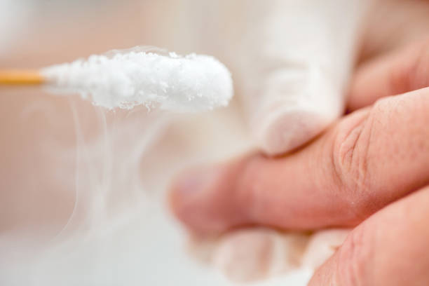 Doctor Applying Cryotherapy on Patient's Skin on Hand Doctor Applying Cryotherapy on Patient's Skin on Hand wart stock pictures, royalty-free photos & images