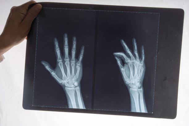 istock X-ray of a 34 year old males right hand 691255028
