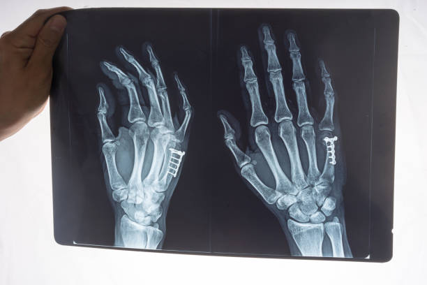 istock X-ray of a 34 year old males right hand 691255240