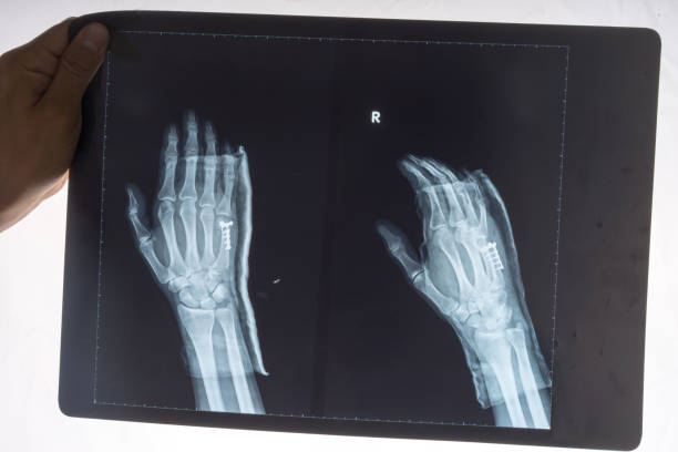 istock X-ray of a 34 year old males right hand 691255244