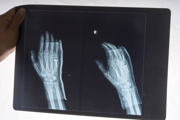 istock X-ray of a 34 year old males right hand 691255476
