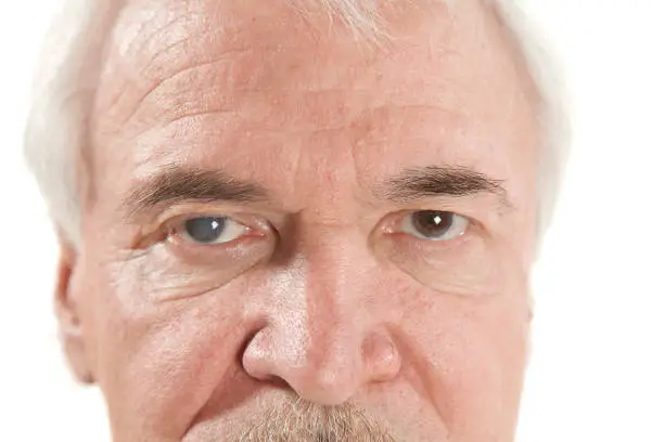 Defeat of the right eye of a man with glaucoma and cataracts is 100%. The initial stage of cataract and glaucoma of the left eye in an elderly man.